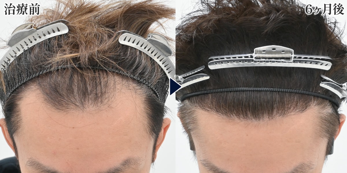 症例写真で見る自毛植毛