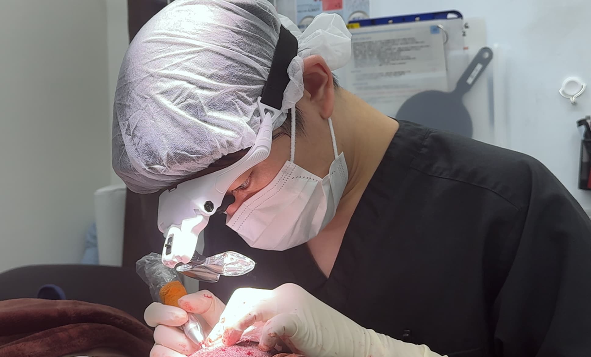 ②豊富な植毛経験に基づいた<strong>「毛根採取技術」</strong>