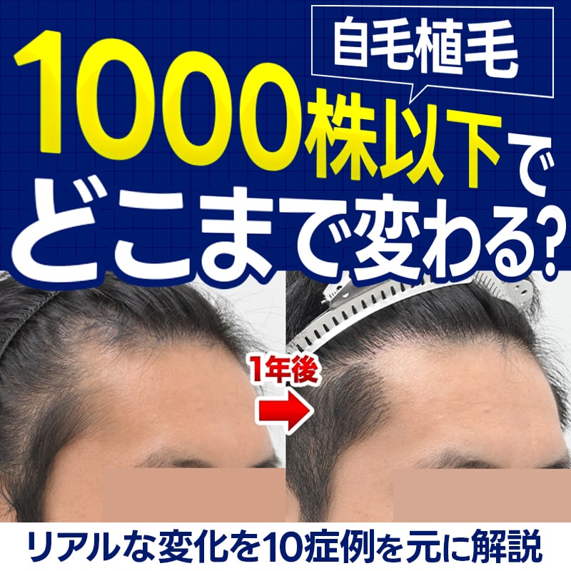 【写真あり】自毛植毛「1000株以下」でどこまで変わる？M字や生え際の変化を10症例で徹底解説