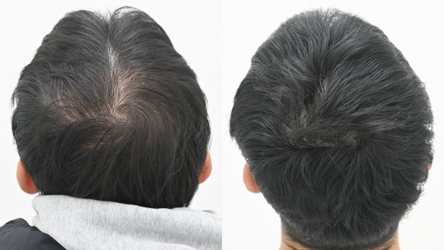 【AGA薄毛治療】20代の薄毛の悩みを改善　毛根再生注射と臍帯幹細胞メソセラピー
