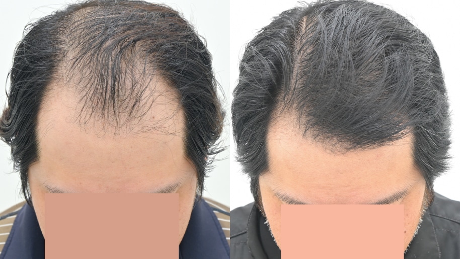 【AGA薄毛治療】毛根再生注射と臍帯幹細胞上清液メソで劇的変化