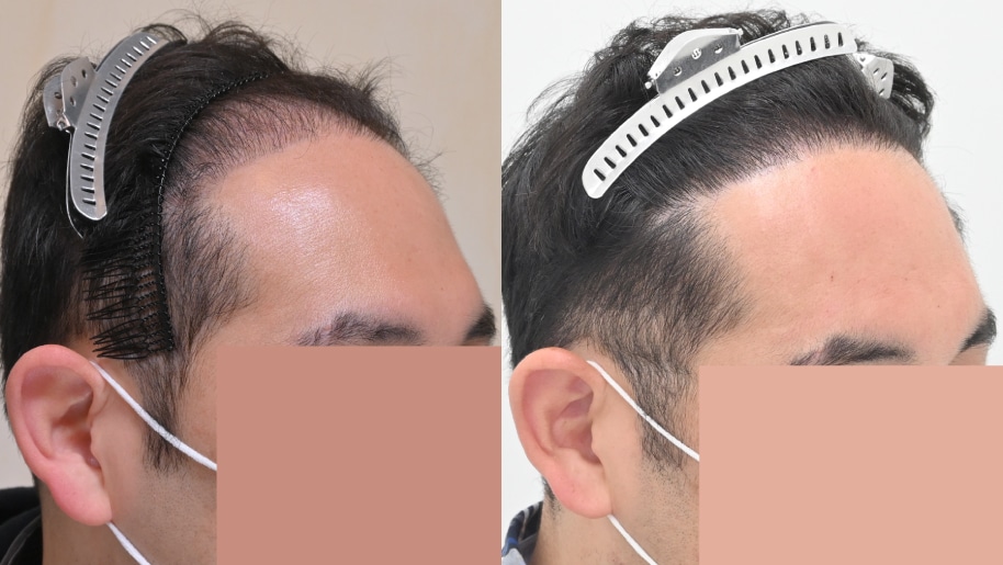 【AGA薄毛治療】二回目の手術で密度アップ