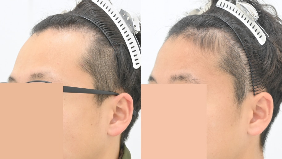 【AGA薄毛治療】20代で髪が減ってしまっている人必見　早期治療をすると改善出来ます。