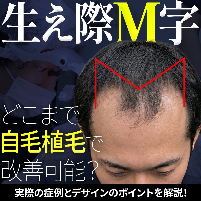 【画像で見る】AGAで後退した「おでこ・M字」を自毛植毛で改善！