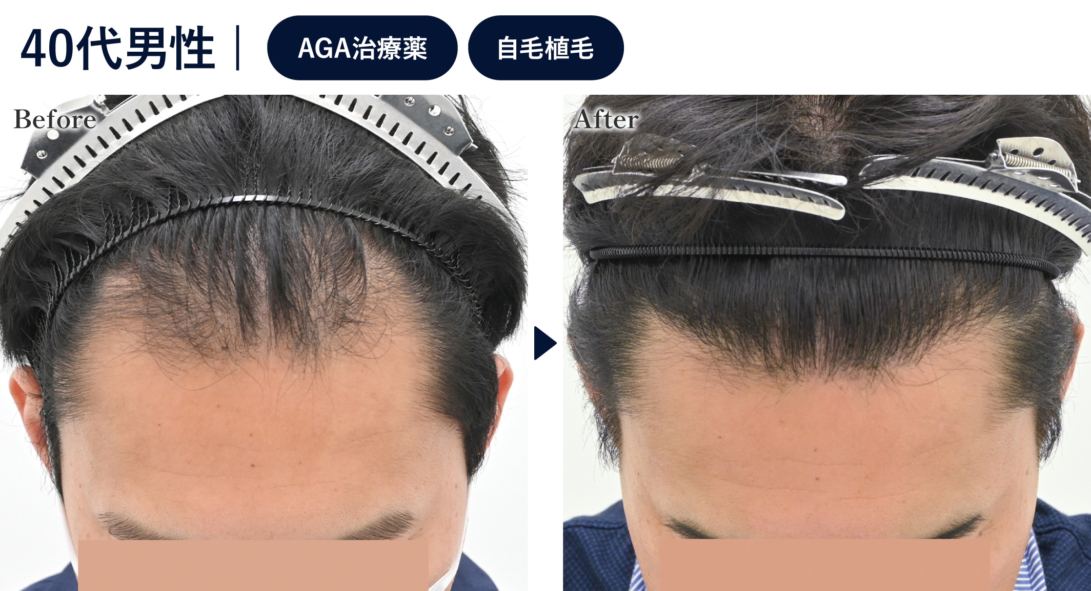 治療しても生え際があまり改善しなかった方