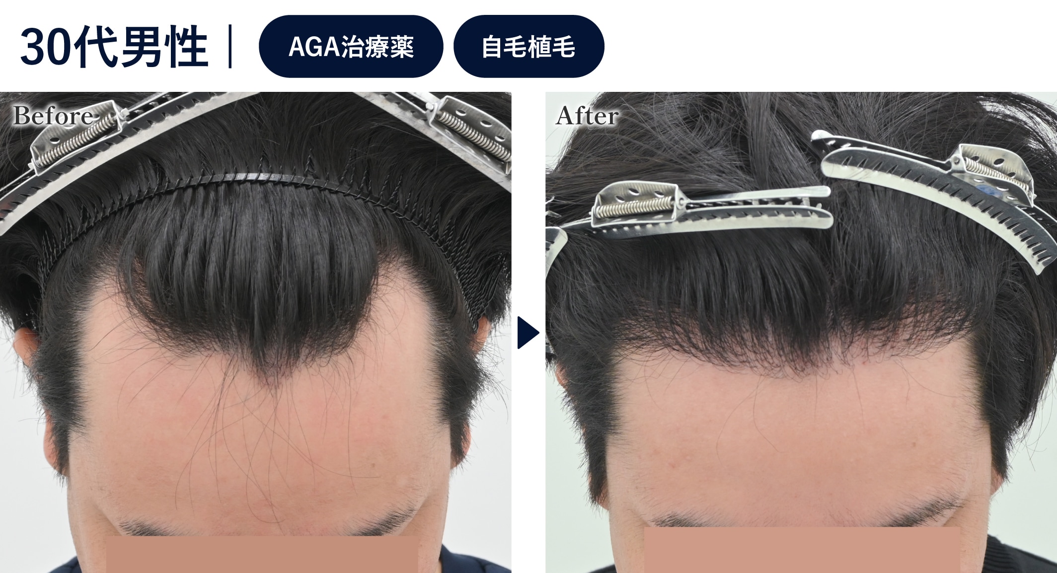 元々の生え際が広い方