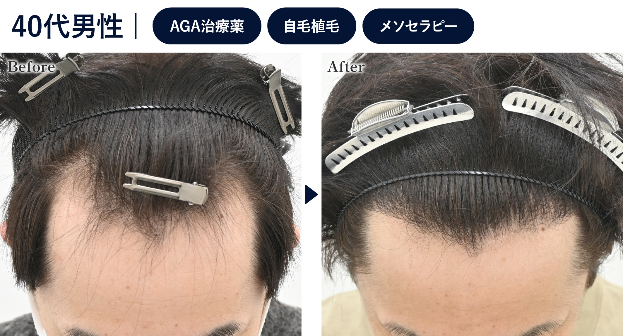 治療歴はあるが毛根がかなり弱っている方