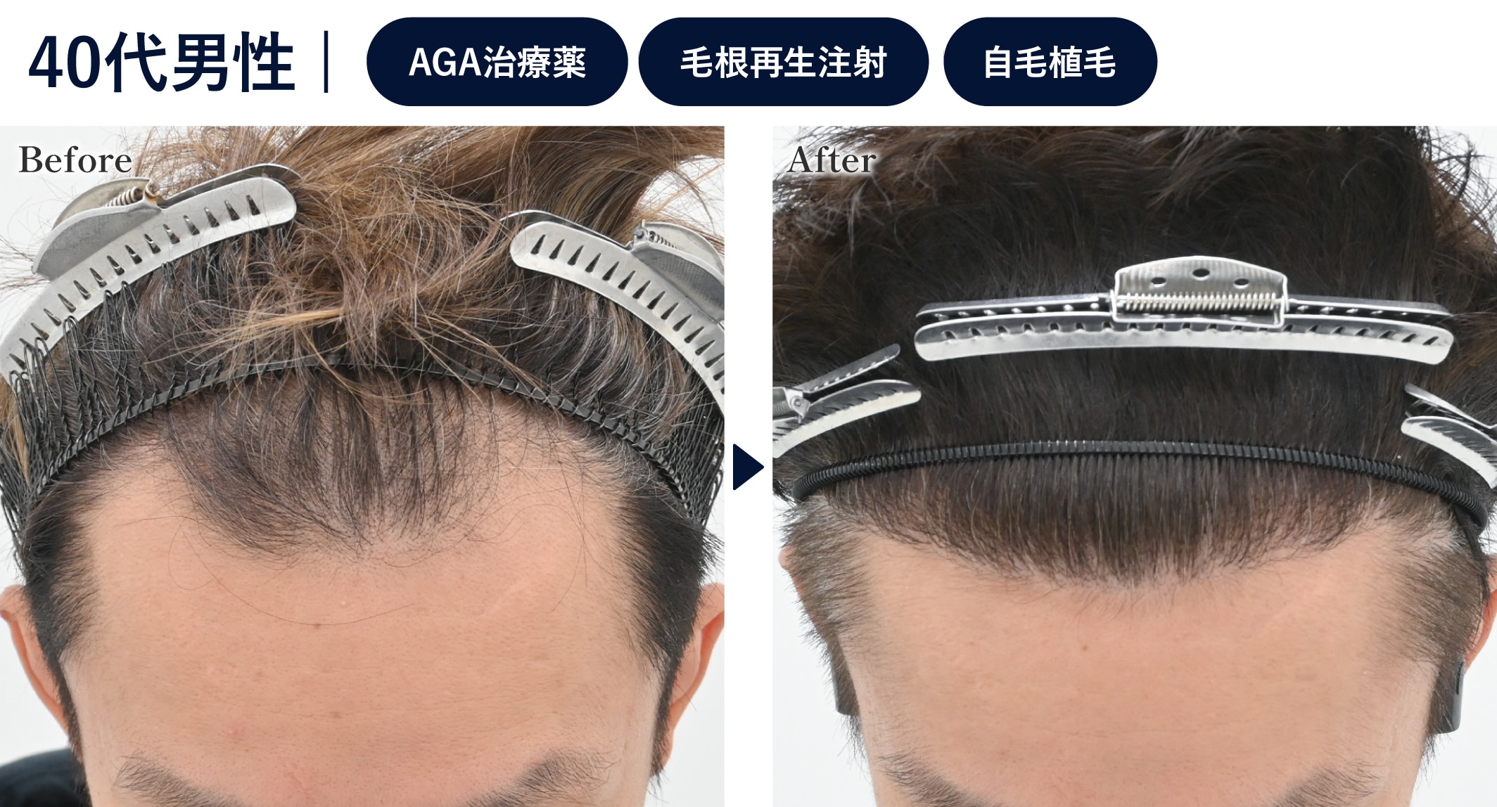 AGA治療薬を内服しても全然改善しなかった方