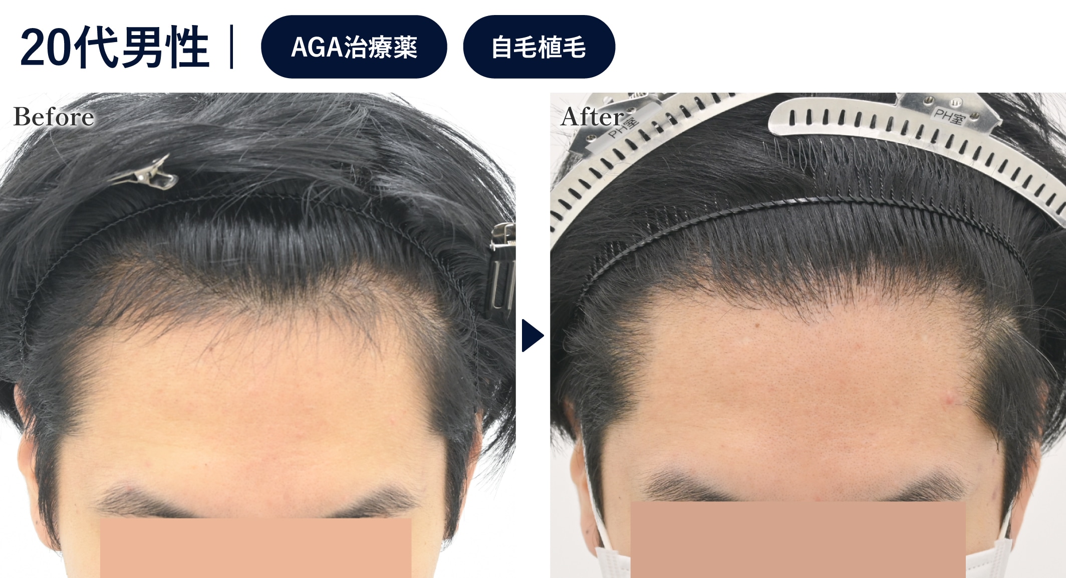 個人輸入で薬を飲んでいた方