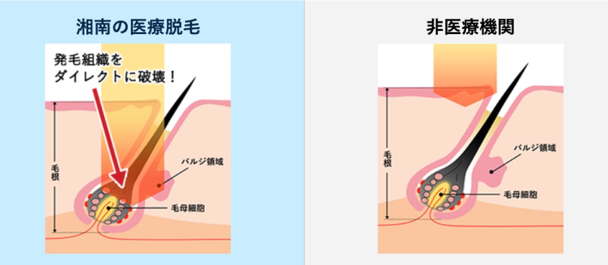 メリット①「多毛化」の副作用を気にせず、AGA治療に専念できる