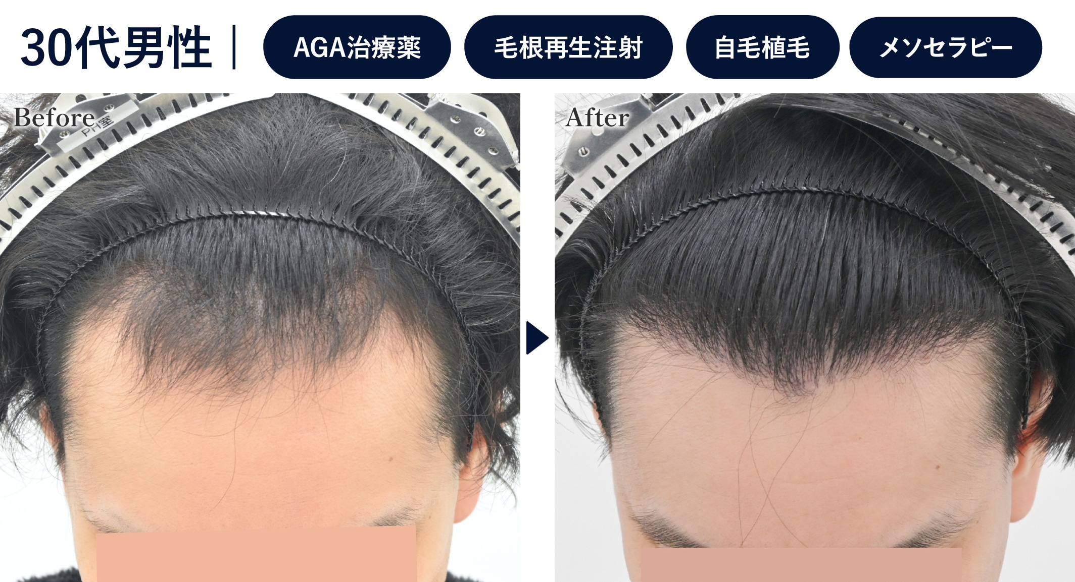 1年前から治療を始めたが生え際が改善しなかった方