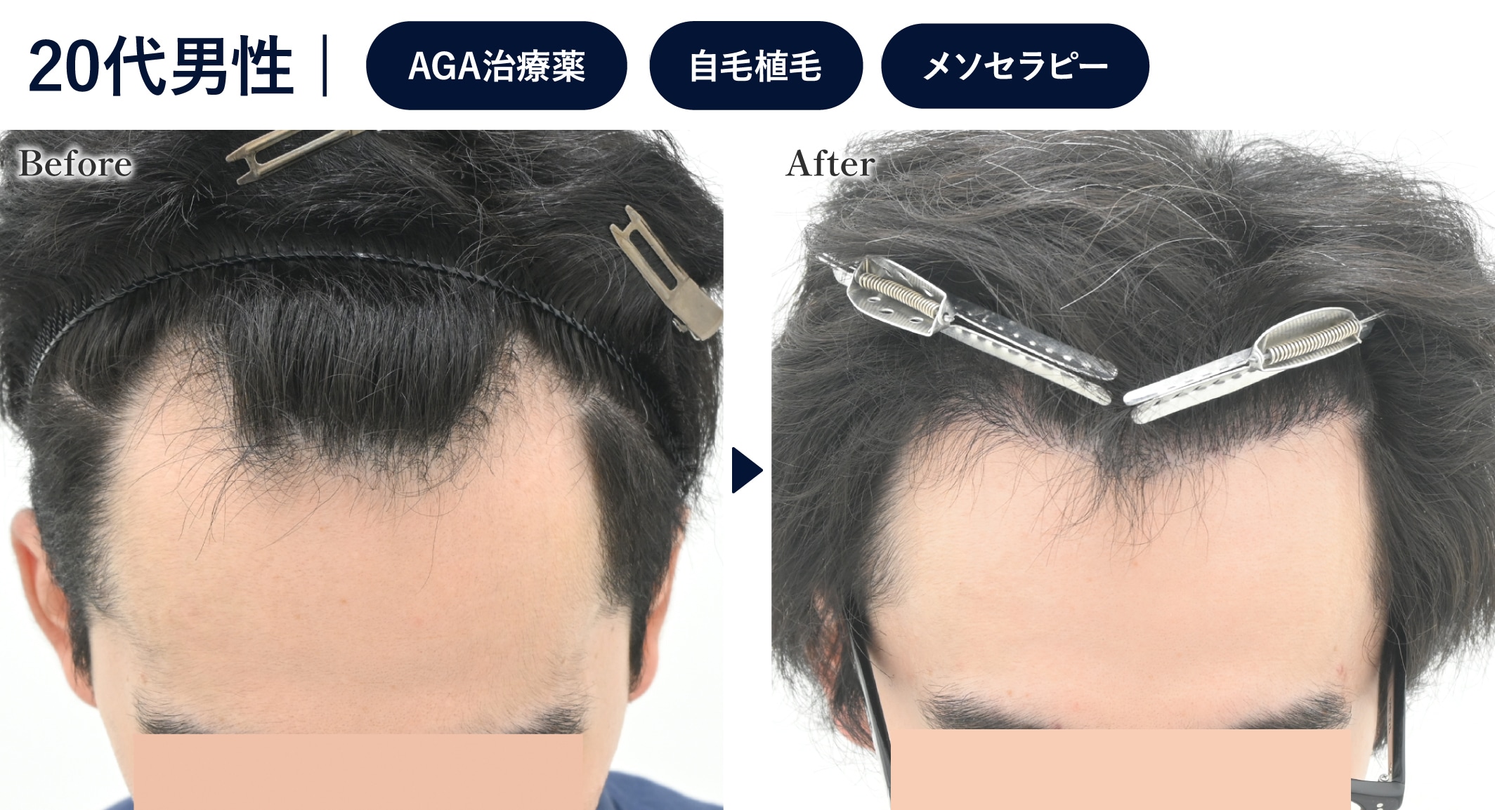 生え際を1cm程狭くしたい方