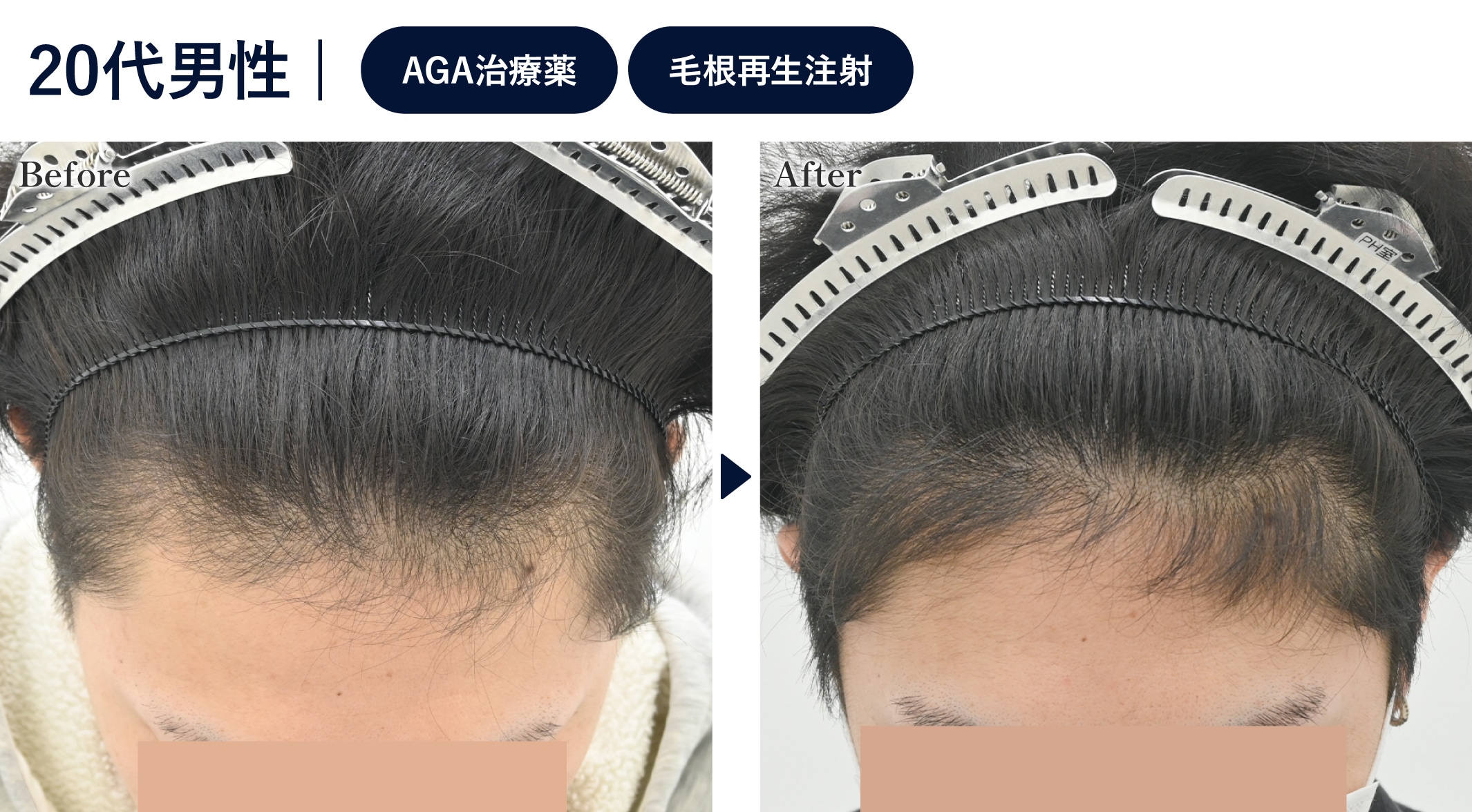 人に指摘されないくらいしっかりボリュームを増やしたい方