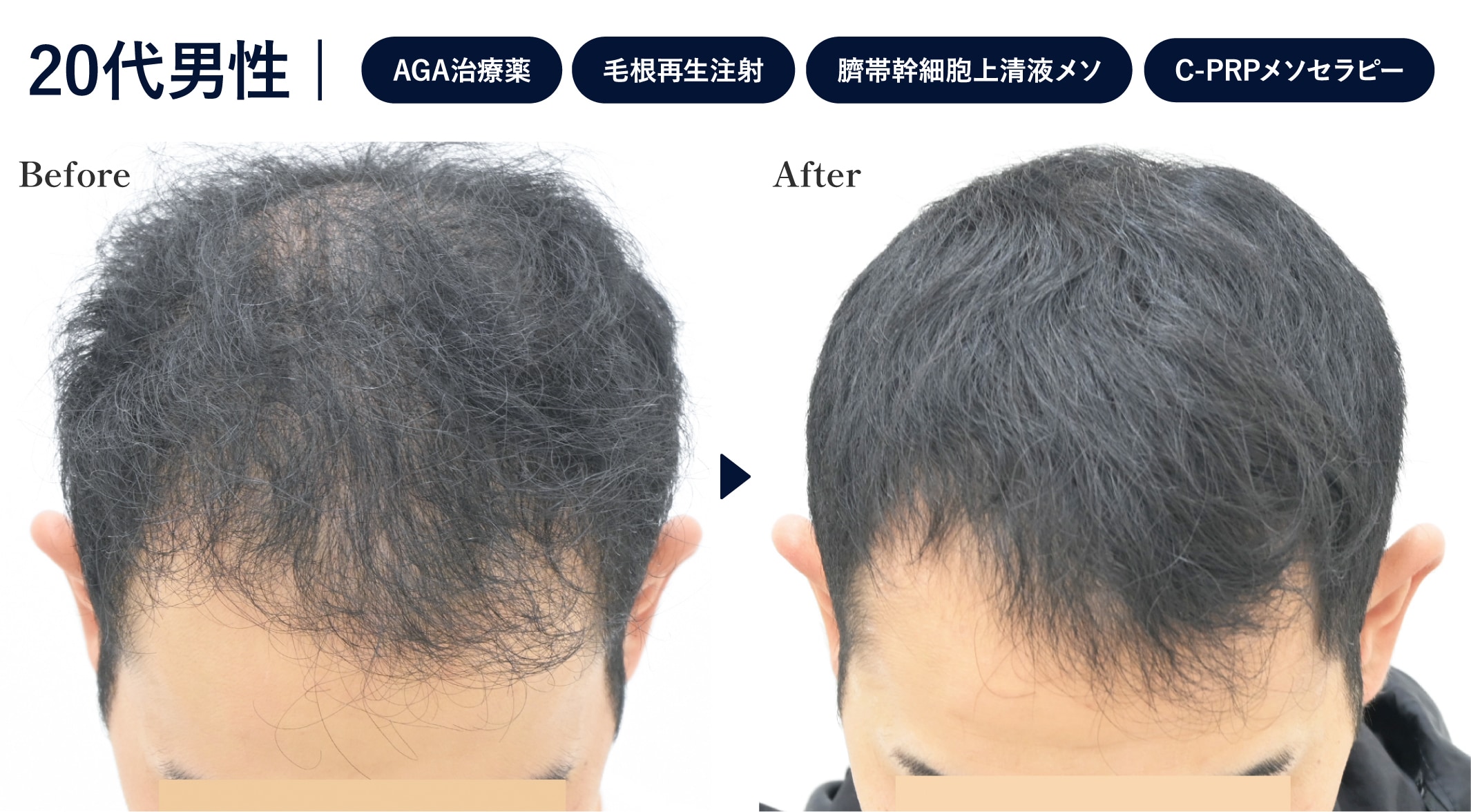 20代でAGAがかなり進行が進んでいる方