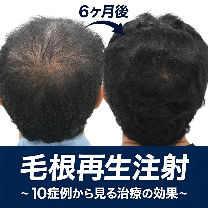 毛根再生注射は効果ある？｜10症例から見る治療効果