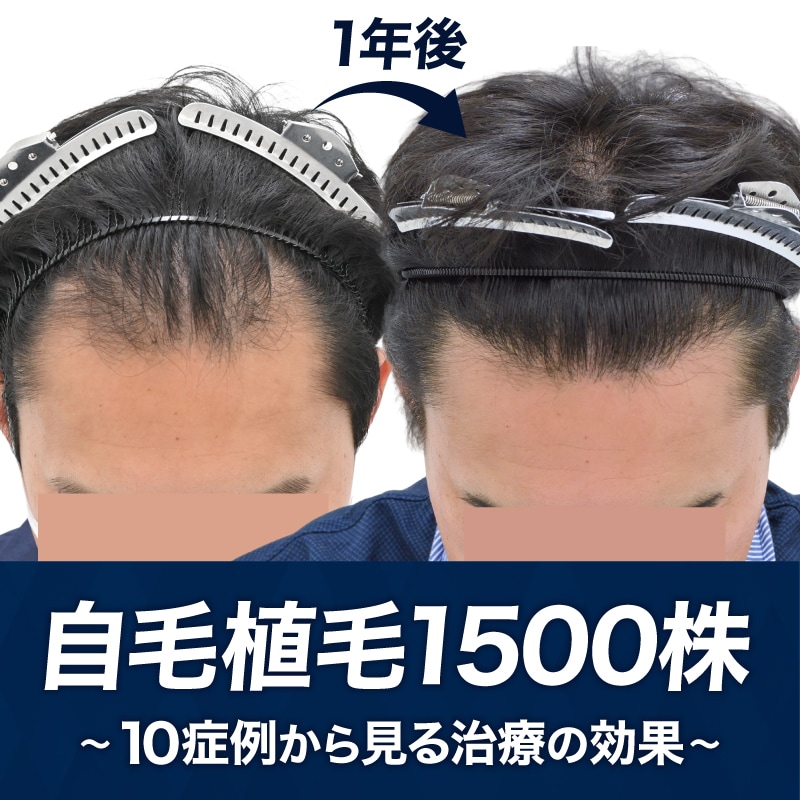 自毛植毛1500株以上でどこまで変わる?|10症例から見る治療効果