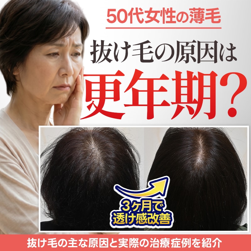 【50代女性の薄毛】抜け毛の原因は更年期？育毛剤とクリニックでの治療の違い