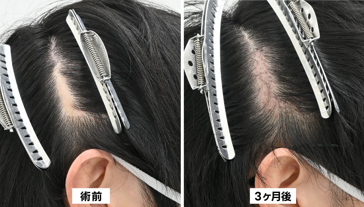 術後3ヶ月の経過