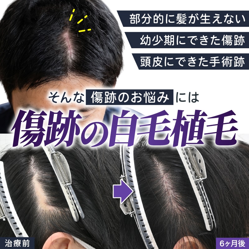 【症例写真あり】傷跡の無毛部は自毛植毛で改善可能？