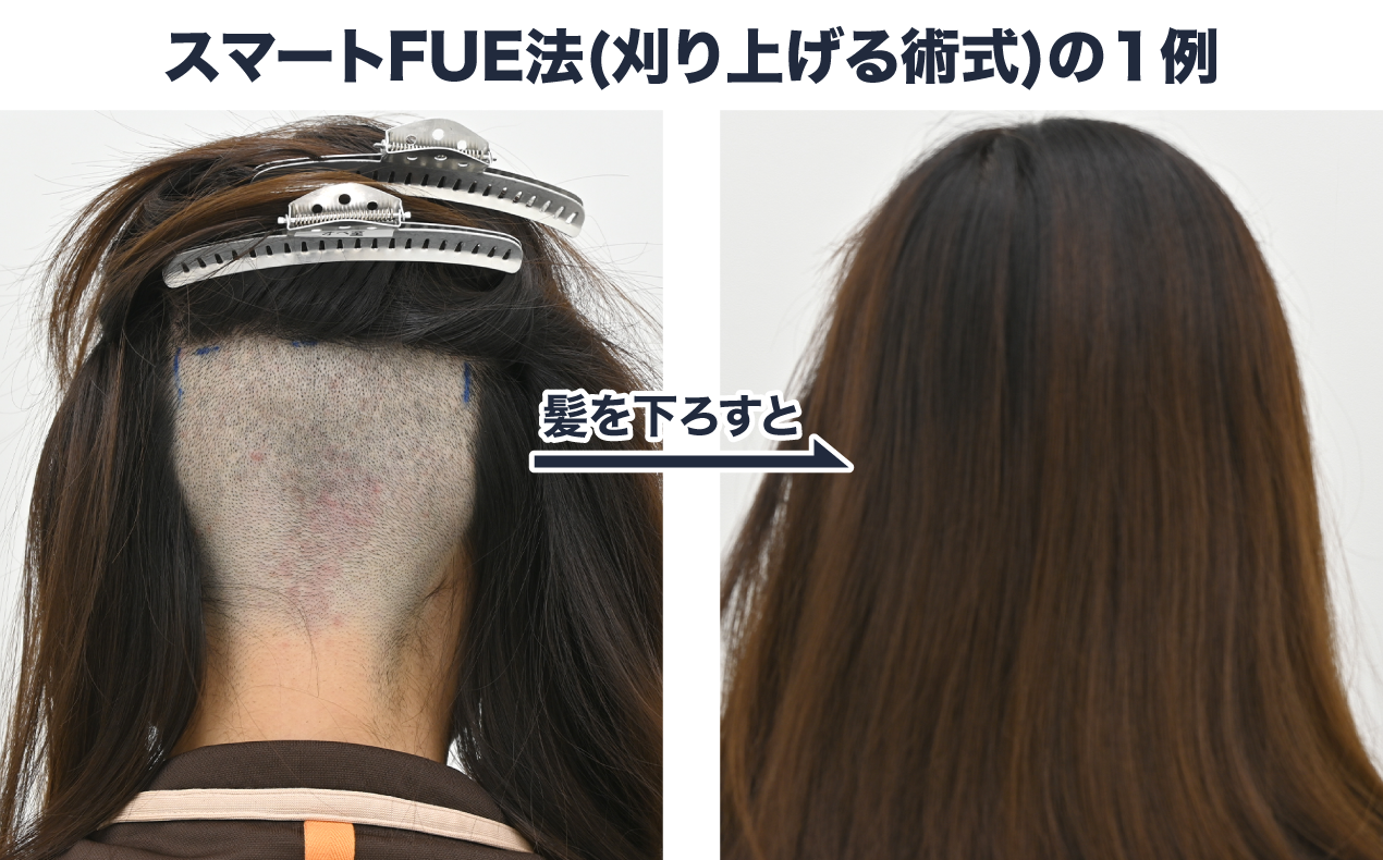 刈り上げ
