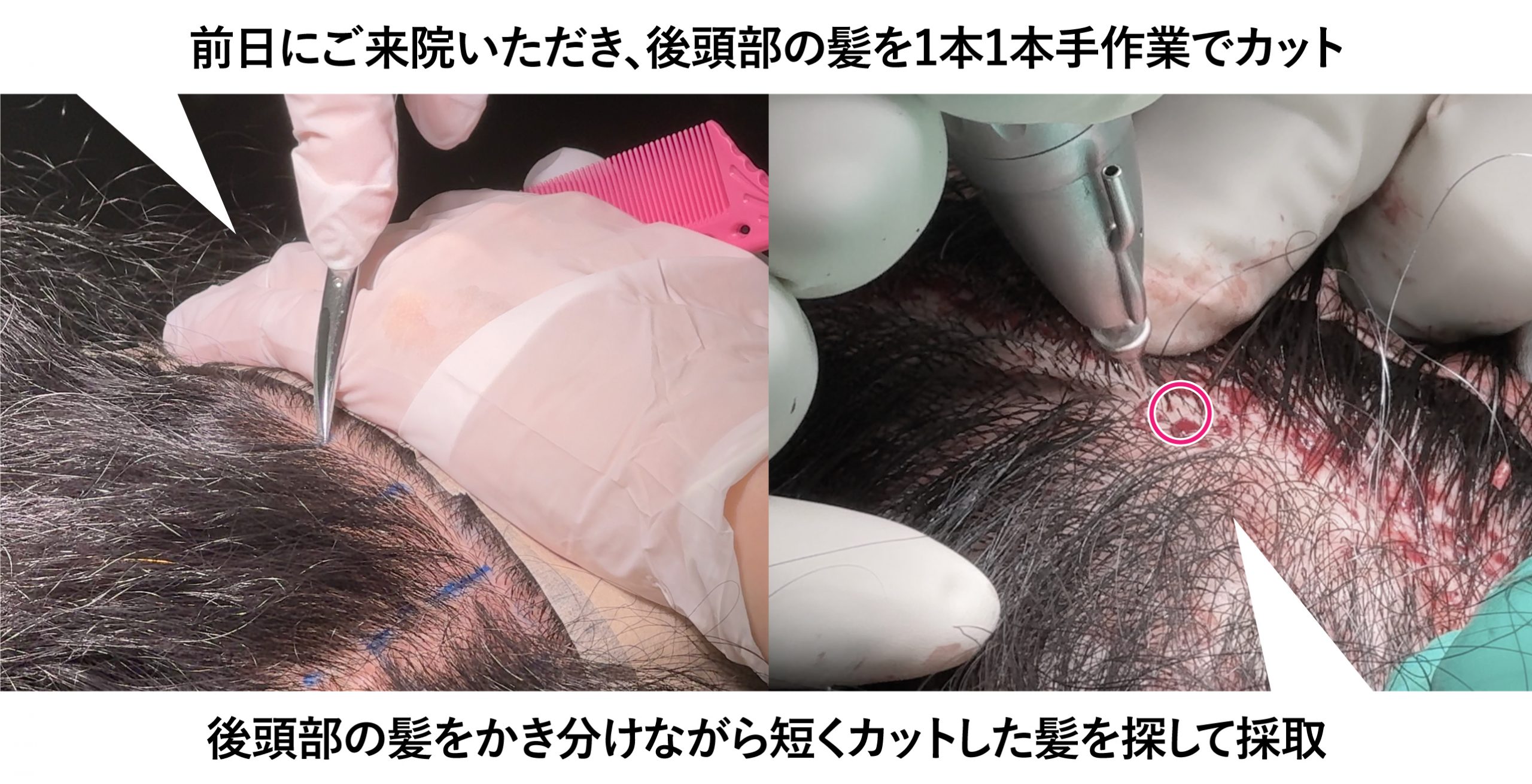 刈り上げない自毛植毛