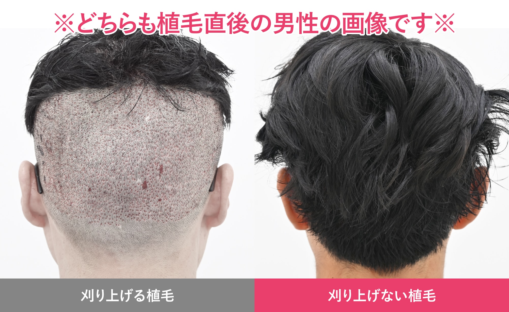 刈り上げない