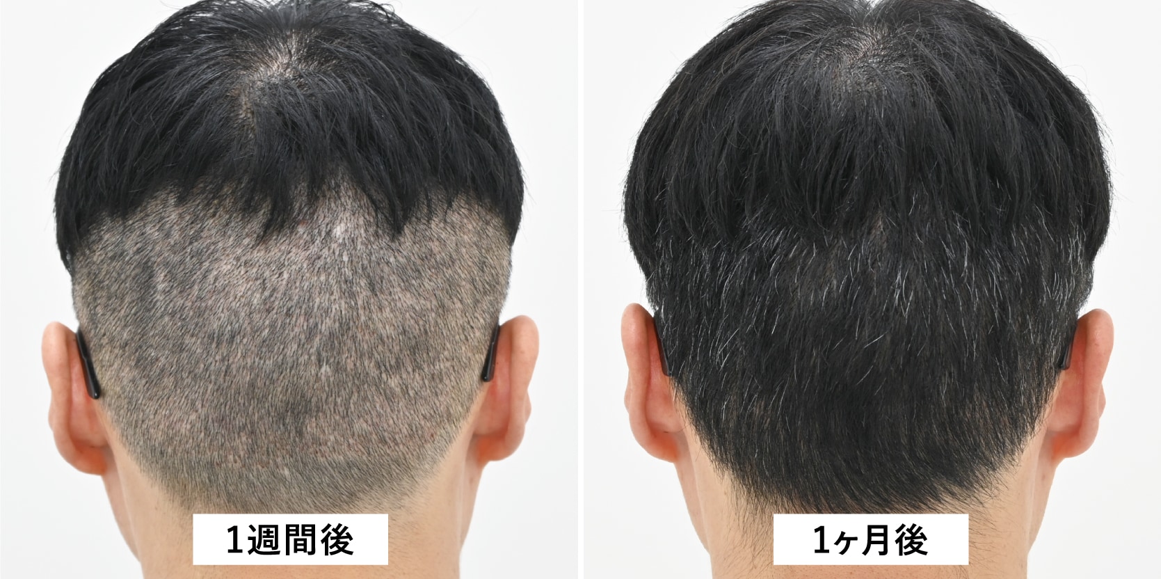 術後1週間〜1ヶ月
