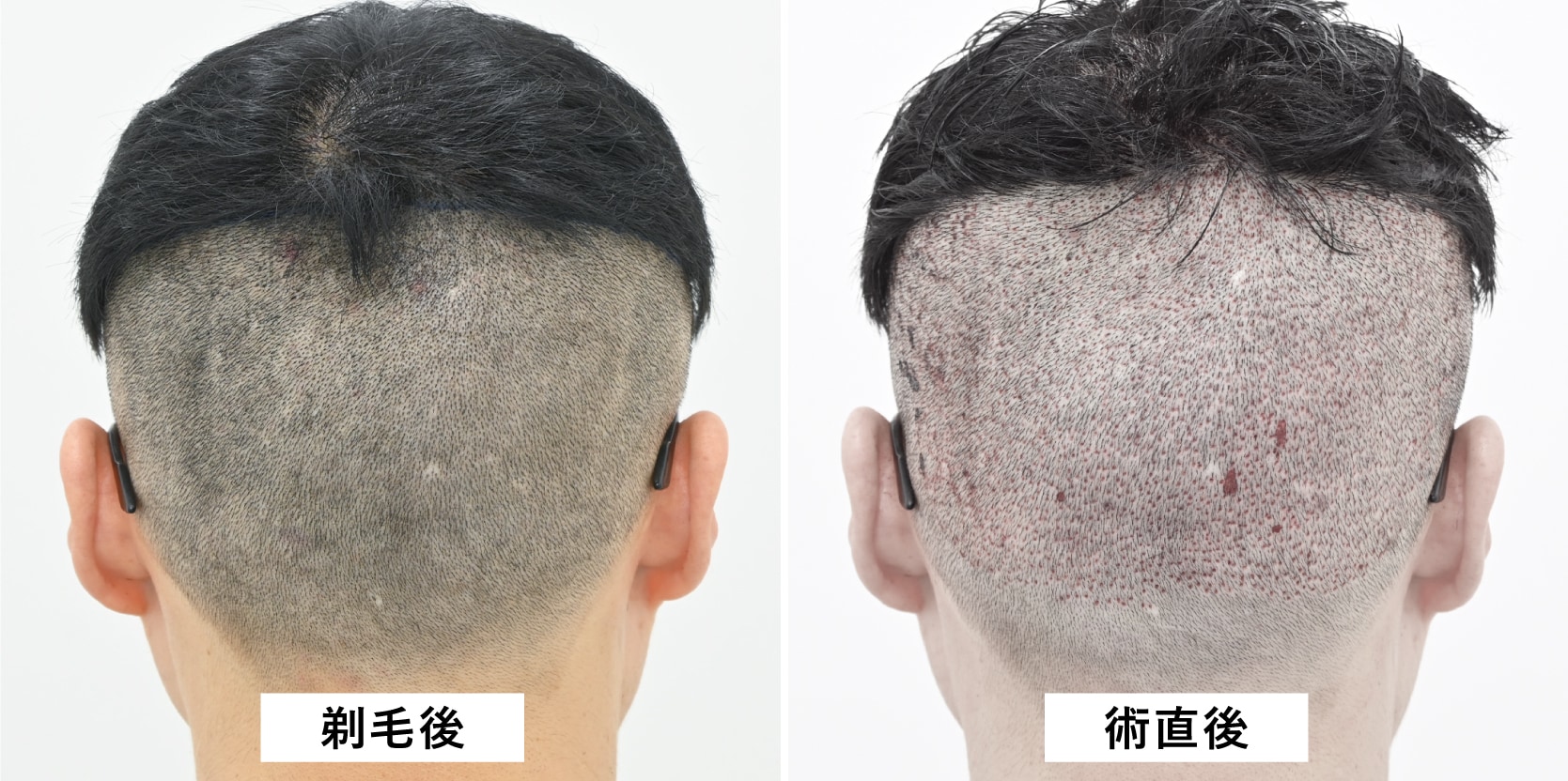 剃毛後〜手術直後