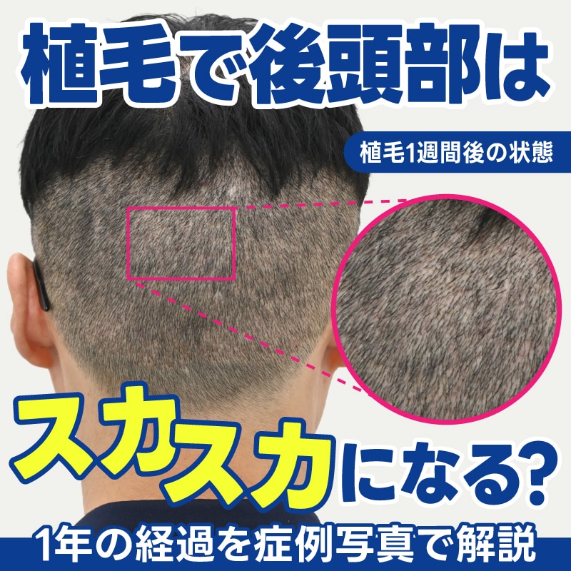 自毛植毛で後頭部の採取部分はスカスカになる？術後1年までの経過を症例写真で解説