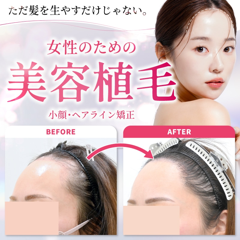 【症例あり】女性のおでこは植毛で狭くできる！女性が植毛をするメリットを解説