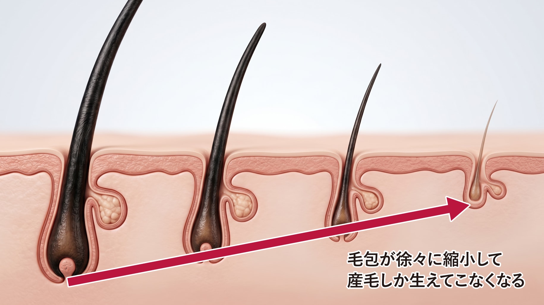 毛包のミニチュア化(軟毛化)が起きる