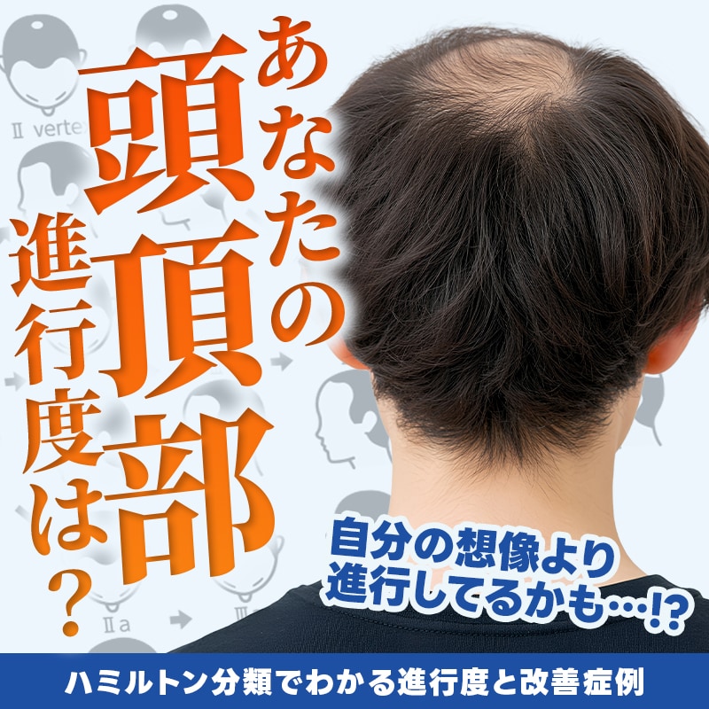 男性の「頭頂部が薄い」原因は？ハミルトン分類でわかる進行度と改善症例