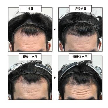 1日目、6日目、1ヶ月後、3ヶ月後の経過