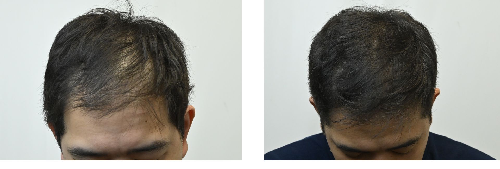 AGA治療薬＋毛根再生注射の症例写真 治療前と治療3ヶ月後の比較