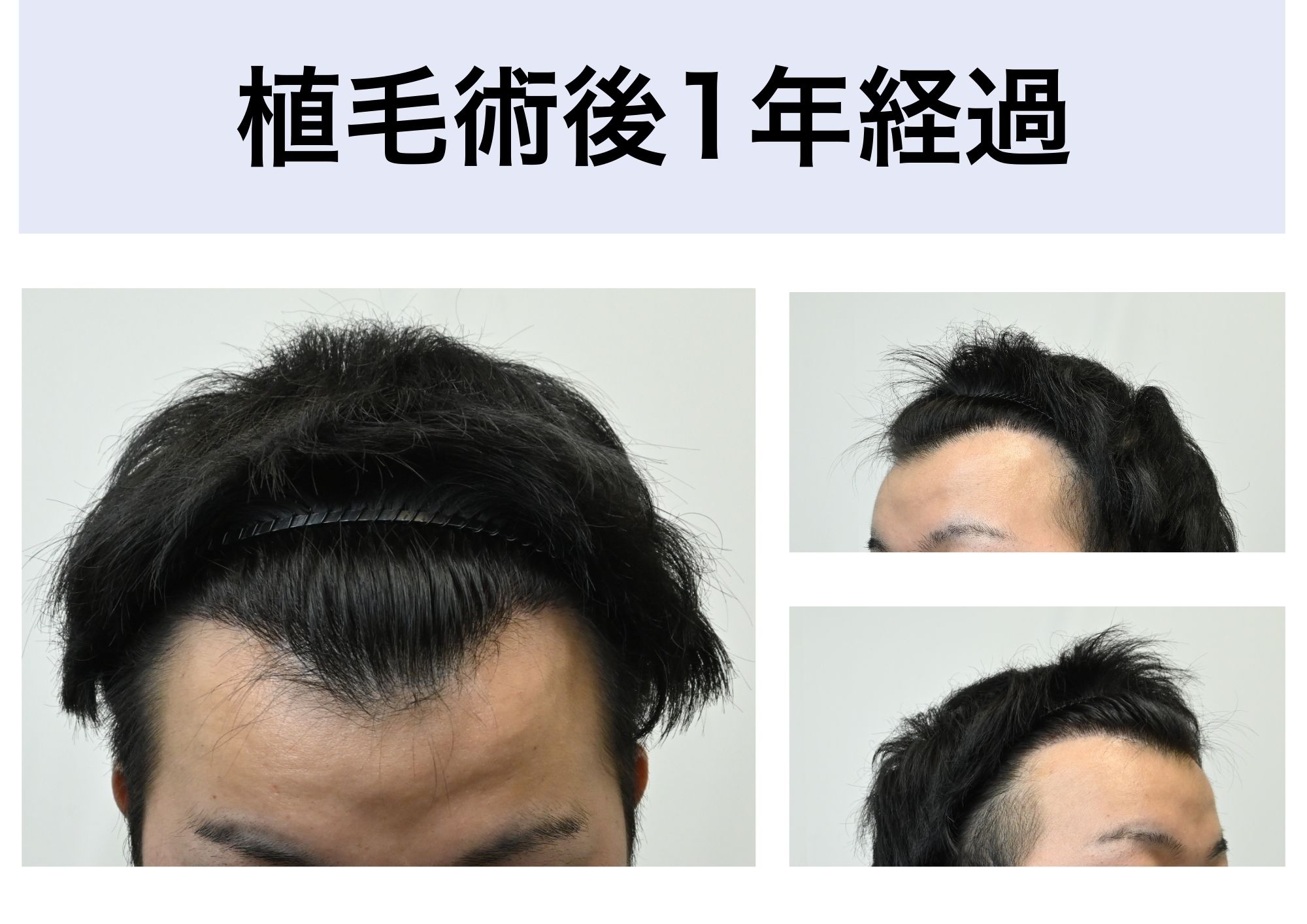 植毛手術後1年経過