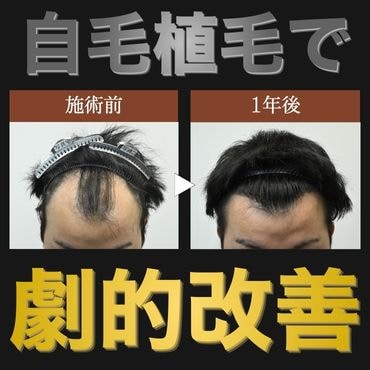 【劇的改善】自毛植毛1年後の経過を大公開！
