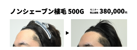 ノンシェーブン植毛の症例写真 治療前と治療6ヶ月後の比較