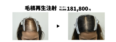 毛根再生注射の症例写真 治療前と治療3ヶ月後の比較
