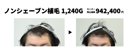 ノンシェーブン植毛と臍帯幹細胞上清液メソ3回の症例写真 治療前と治療6ヶ月後の比較