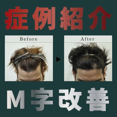 お盆休みに関西で植毛をお考えの方