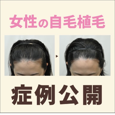 女性の自毛植毛症例紹介