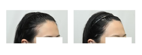 自毛植毛(FUE)の症例写真 手術前と手術1年後の比較
