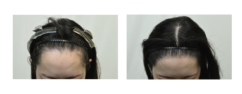 自毛植毛(ノンシェーブン)の症例写真 手術前と手術6ヶ月後の比較