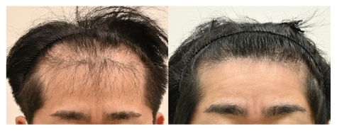 40代男性：HRタブレットセット＋毛根再生注射(3ヶ月の変化)の症例写真 治療前と治療3ヶ月後の比較