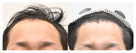 30代男性：1500グラフト植毛手術(12ヶ月の変化)の症例写真 治療前と治療12ヶ月後の比較