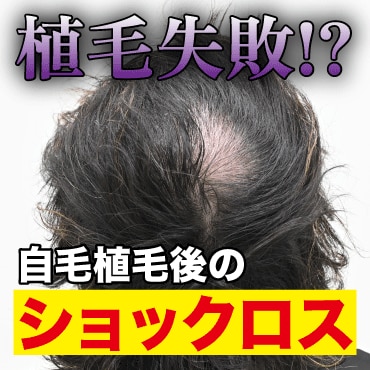 【植毛失敗!?】自毛植毛によるショックロスについて原因と対処法とは？