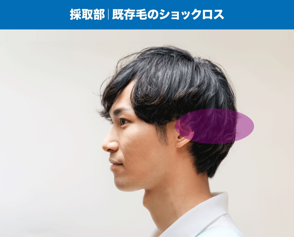 採取部のショックロス