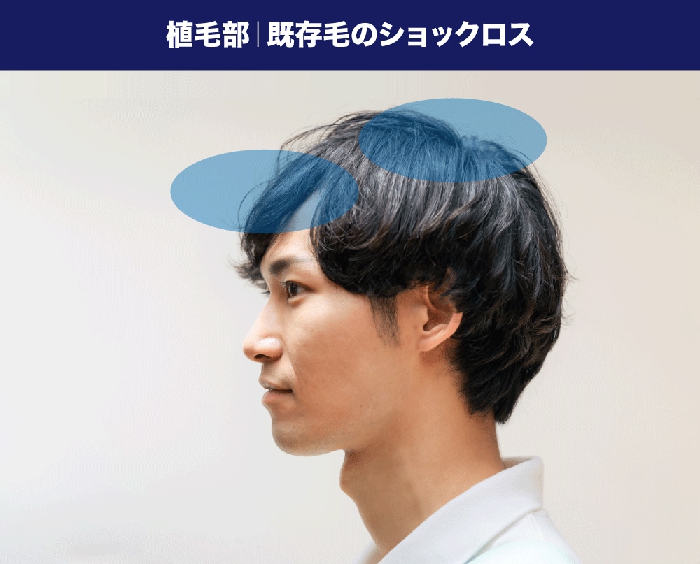 既存毛のショックロス
