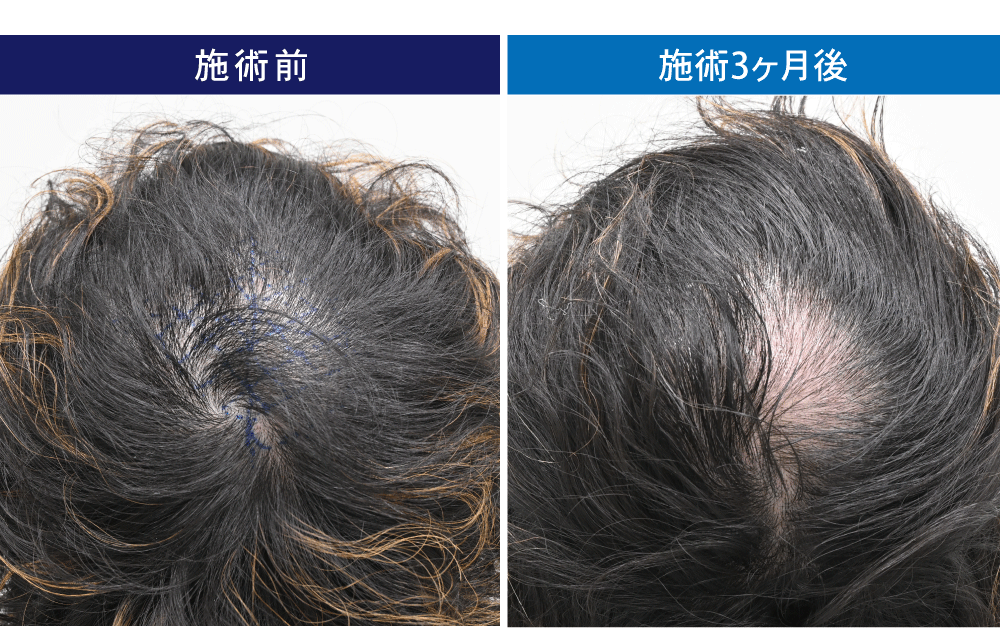 植毛によってショックロスになってしまった症例