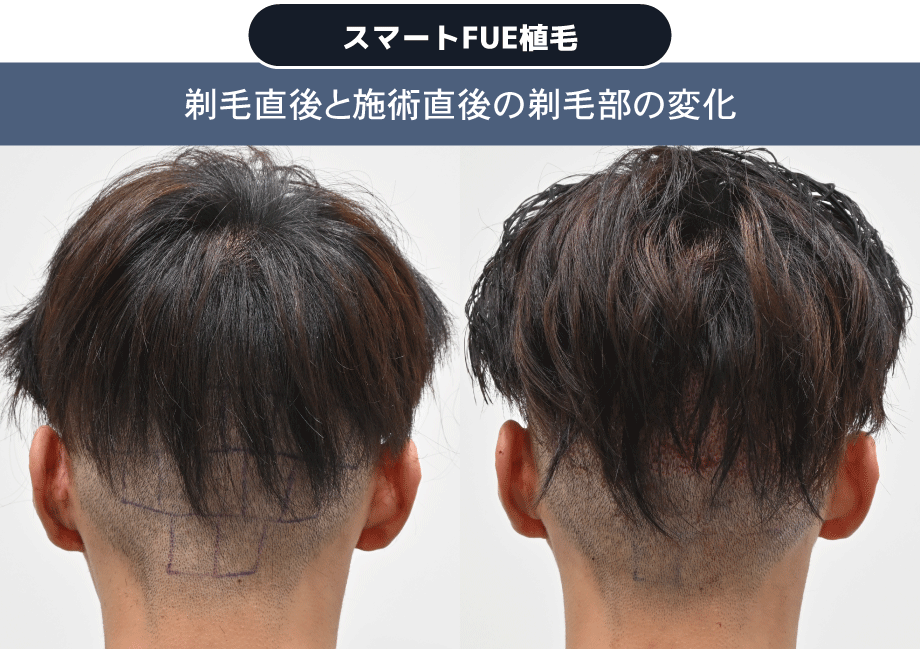 植毛はしたいが、費用を少しでも抑えたい方にスマートFUE植毛